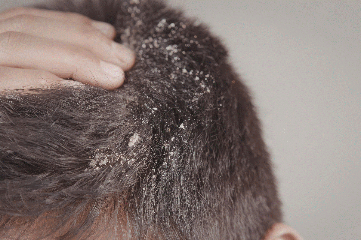Dandruff Ayurvedic treatment